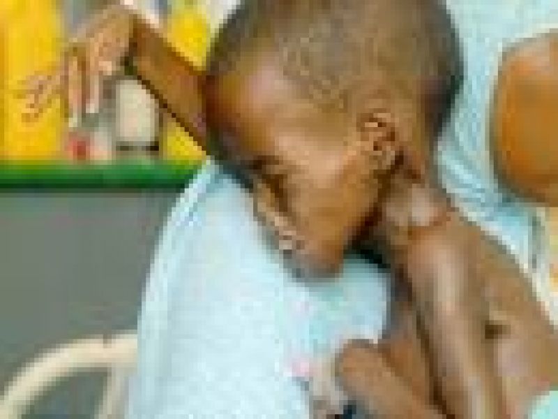 83 % من أطفال شرق السودان يعانون من سوء التغذية