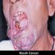 وزارة الصحة 188 حالة سرطان تستقبلها مستشفي الاسنان سنوياً
