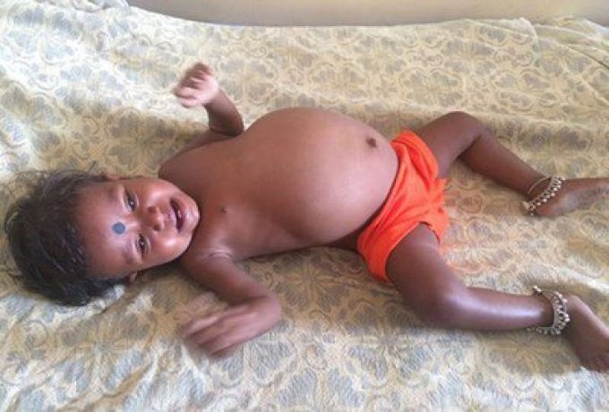 اكتشاف «جنين» في بطن طفلة وزنه 3.5 كغم